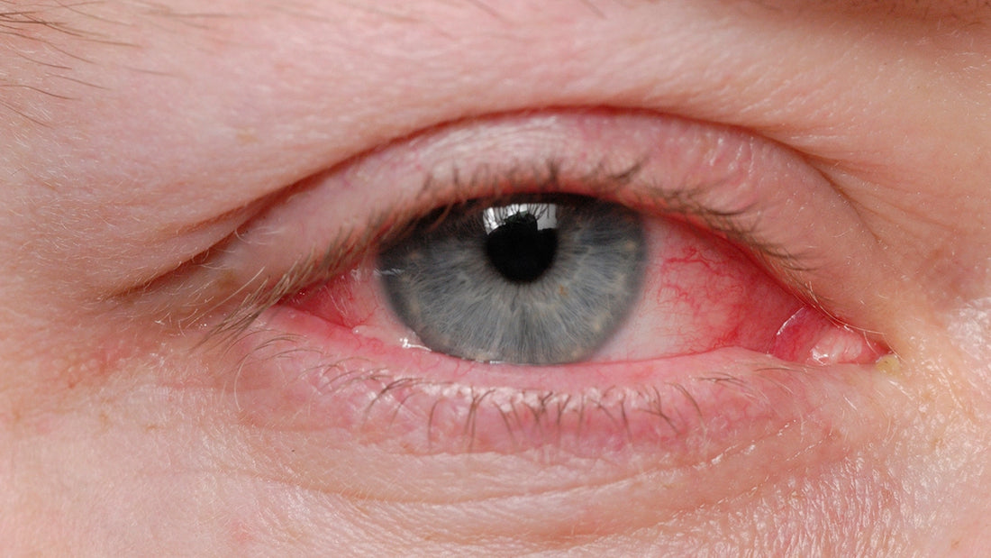 Conjonctivitus